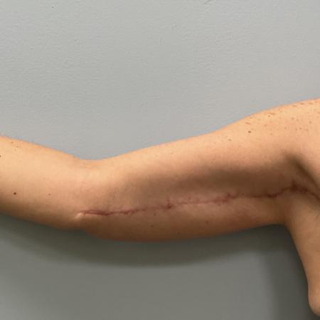 After image 4 Case #108161 - Tummy Tuck & Arm Lift