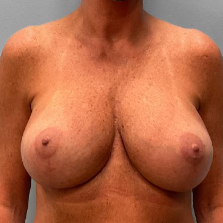 After image 1 Case #108081 - Breast Revision