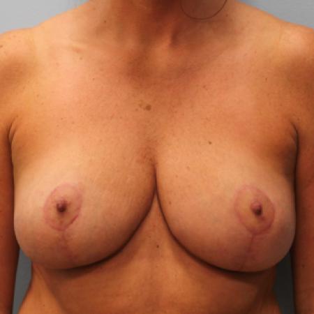 After image 1 Case #107536 - Breast Reduction