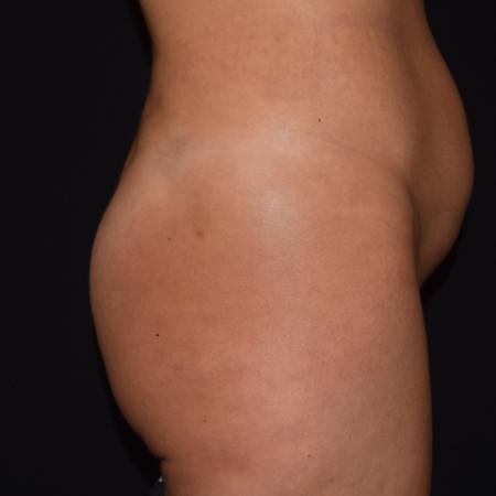 Before image 4 Case #107886 - Female Liposuction & Fat Transfer