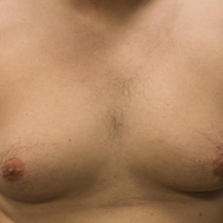 Before image 1 Case #108141 - Gynecomastia