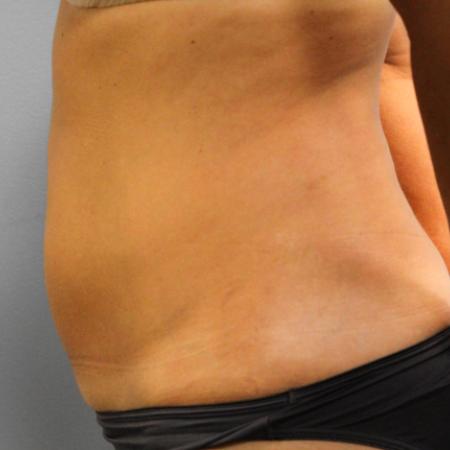 Before image 3 Case #107711 - SmartLipo