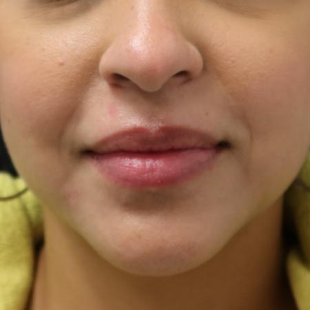 After image 1 Case #107936 - Cosmetic Mole Removal (Nose, Upper Lip & Chin)