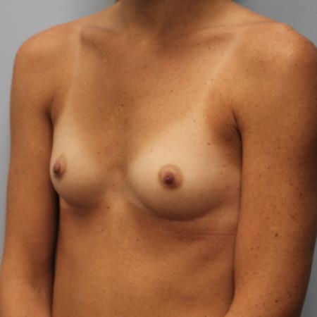 Before image 2 Case #107531 - Breast Augmentation