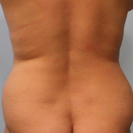 Before image 4 Case #108106 - Tummy Tuck