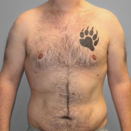 After Case #107946 - SmartLipo