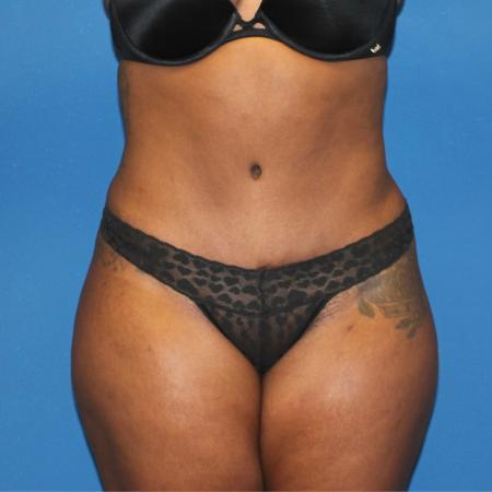 After image 1 Case #107521 - Mommy Makeover