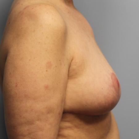 After image 3 Case #107626 - Breast Revision