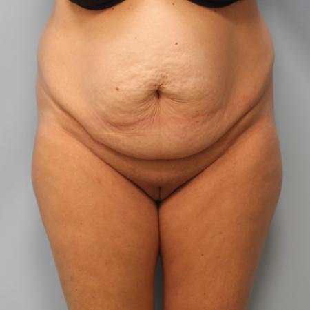 Before image 1 Case #107656 - Tummy Tuck