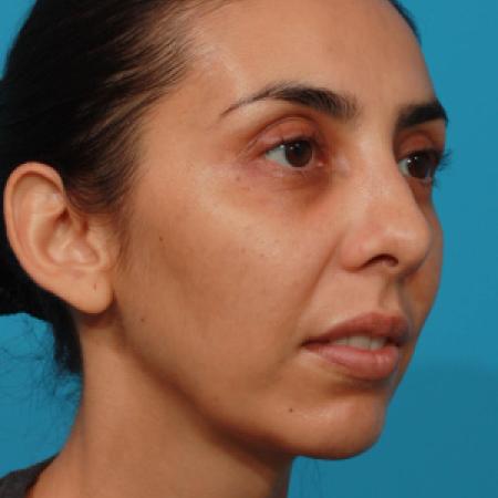 After image 2 Case #108301 - Chin Augmentation