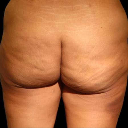 After Case #107931 - Avéli® Cellulite Treatment