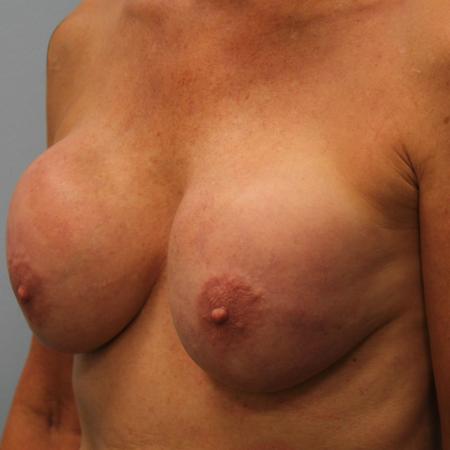 Before image 2 Case #107821 - Breast Revision