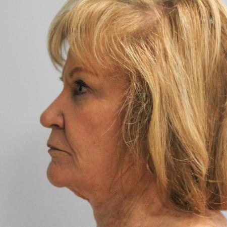 Before image 3 Case #107611 - Facelift