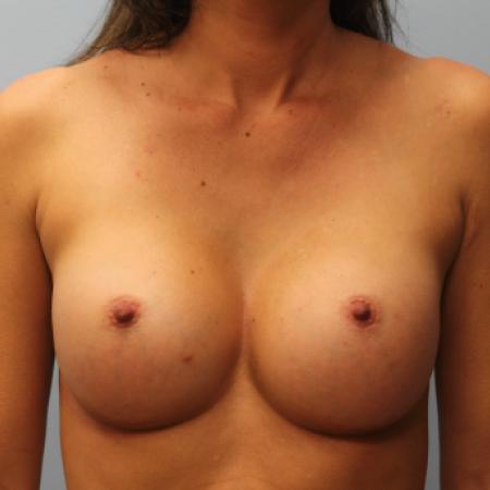 After image 1 Case #108091 - Breast Augmentation