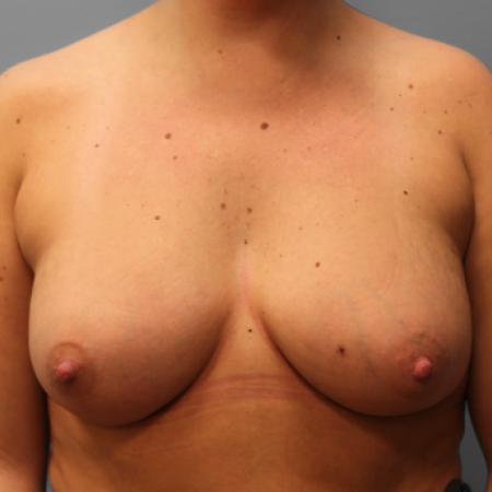 After image 1 Case #107811 - Breast Augmentation