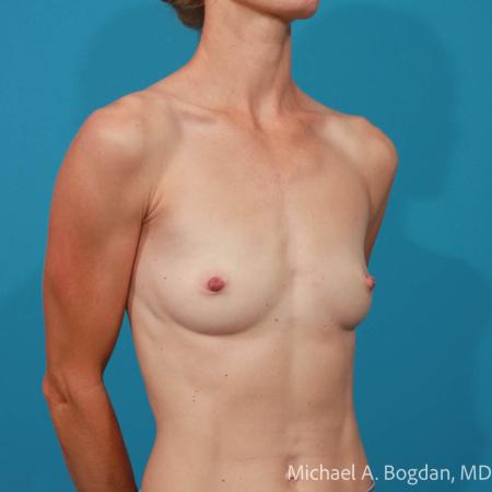 Before image 2 Case #108306 - Breast Augmentation