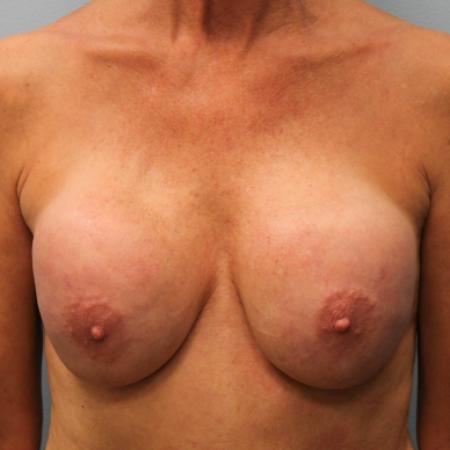 Before image 1 Case #107821 - Breast Revision