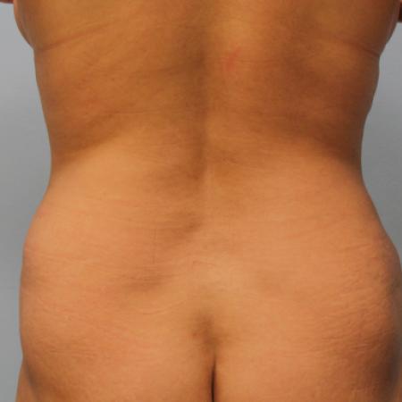 After image 4 Case #108106 - Tummy Tuck