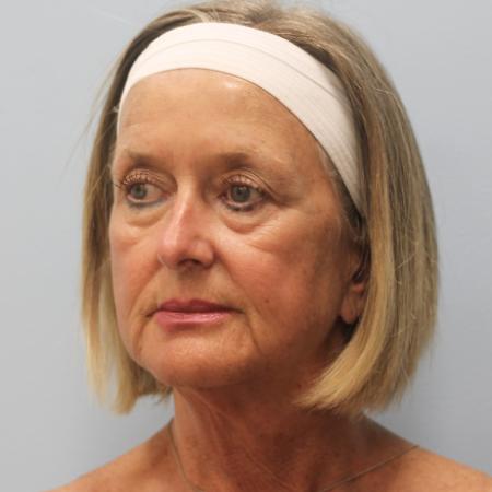 Before image 2 Case #108171 - Facelift, Browlift, & Blepharoplasty