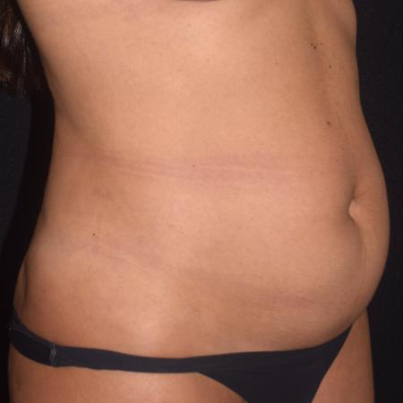 Before image 3 Case #107886 - Female Liposuction & Fat Transfer