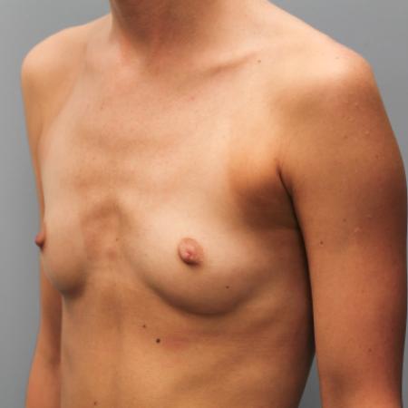Before image 2 Case #108071 - Breast Augmentation