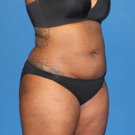 Before image 2 Case #107521 - Mommy Makeover