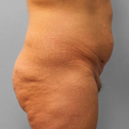 Before image 3 Case #108231 - Abdominoplasty & Lipo