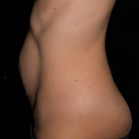 Before image 2 Case #107896 - Abdominoplasty with Muscle Plication/Hernia Repair