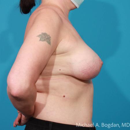 After image 3 Case #108311 - Breast Lift