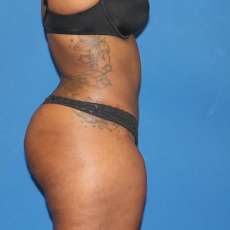 After image 3 Case #107521 - Mommy Makeover