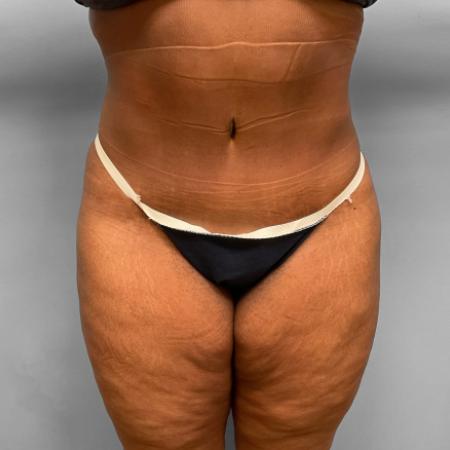 After image 1 Case #108226 - Tummy Tuck & Lipo