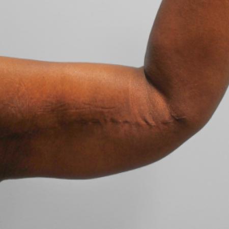 After image 1 Case #108251 - Arm Lift & Lipo
