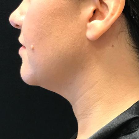 Before image 2 Case #108011 - CoolSculpting for Double Chin