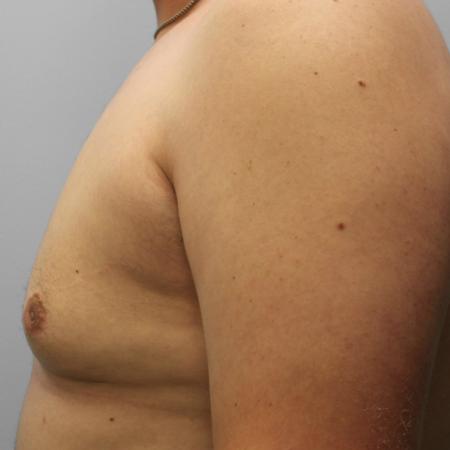 After image 3 Case #108141 - Gynecomastia