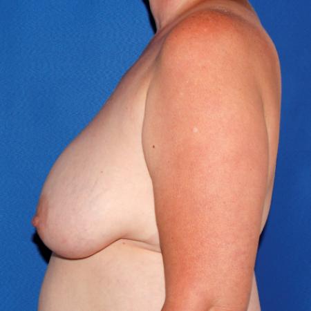 Before image 3 Case #107636 - Breast Lift