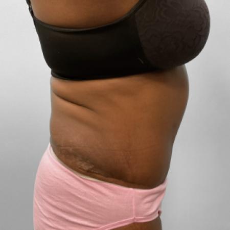 After image 3 Case #107551 - Tummy Tuck 