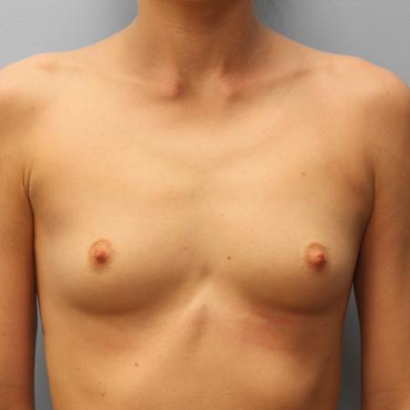 Before image 1 Case #108261 - Breast Augmentation