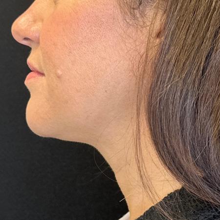After image 2 Case #108011 - CoolSculpting for Double Chin