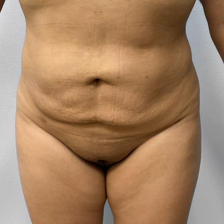 After Case #108131 - Lipo & BBL