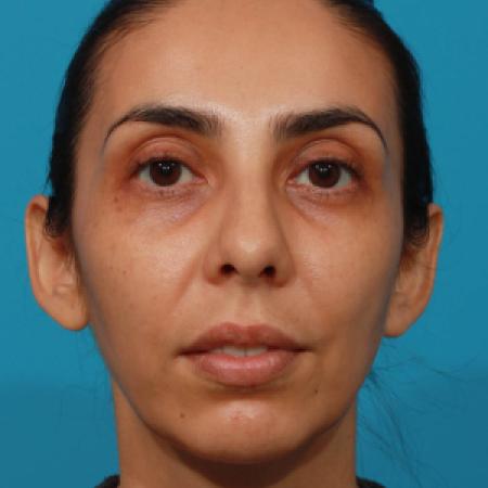 After image 1 Case #108301 - Chin Augmentation