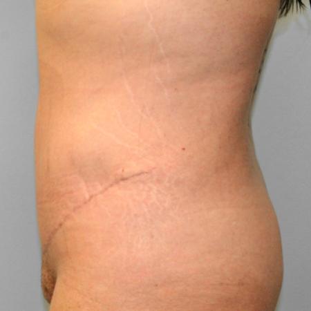 After image 3 Case #107676 - Tummy Tuck