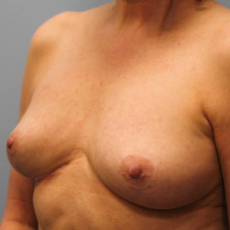 After image 2 Case #107571 - Breast Revision