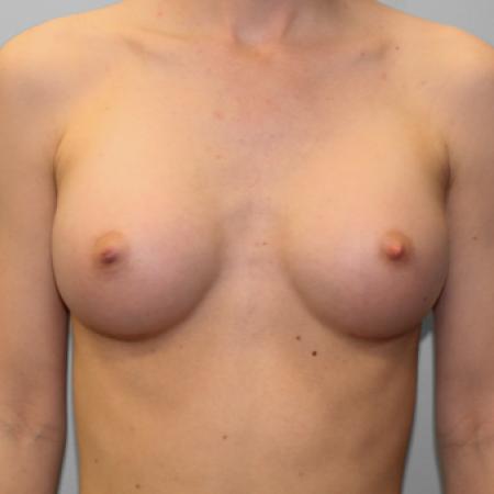 After image 1 Case #108071 - Breast Augmentation