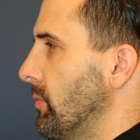After image 1 Case #107641 - Rhinoplasty with Chin Implant