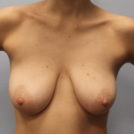Before image 1 Case #108146 - Breast Augmentation & Lift