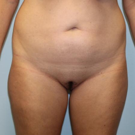 Before image 1 Case #108216 - Liposuction