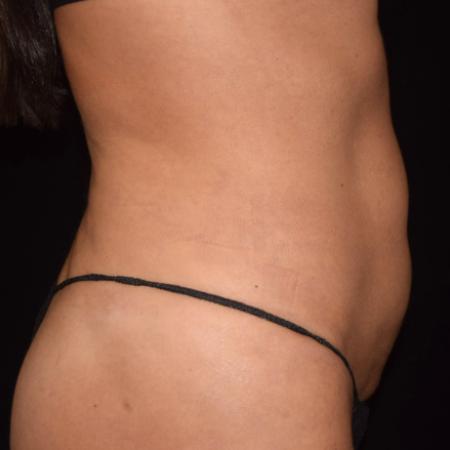After image 2 Case #107886 - Female Liposuction & Fat Transfer