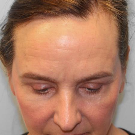 After image 3 Case #108121 - Upper and Lower Blepharoplasty