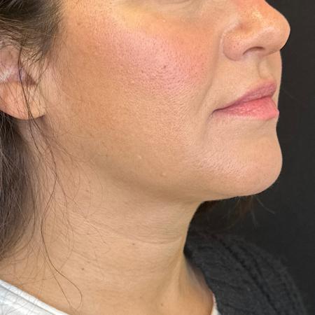 After image 3 Case #108011 - CoolSculpting for Double Chin
