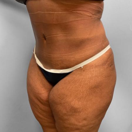 After image 2 Case #108226 - Tummy Tuck & Lipo
